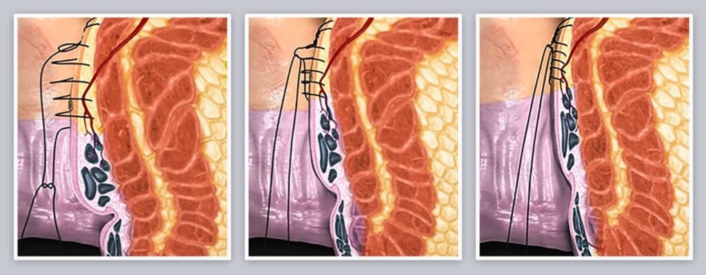 THD-doppler for Hemorrhoid