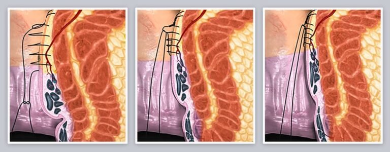 Transanal Hemorrhoidal Deartilization