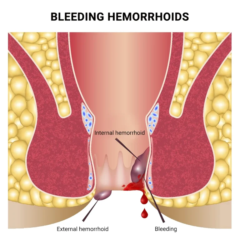 4 Best Treatments for Burst Hemorrhoids
