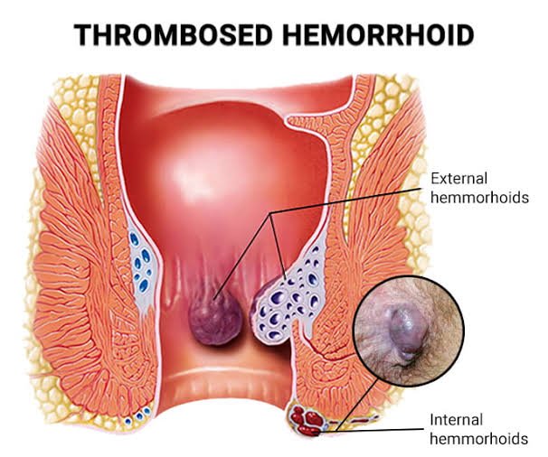 Anatomy of thrombosed hemorrhoid