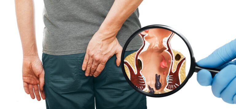 Will Hemorrhoids Go Away on Their Own?
