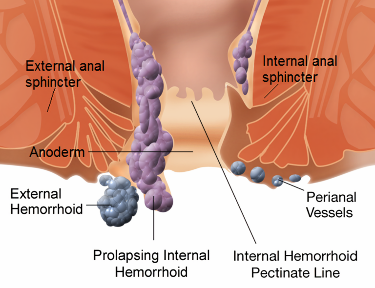 Understanding the Different Types of Hemorrhoids and Treatment Options