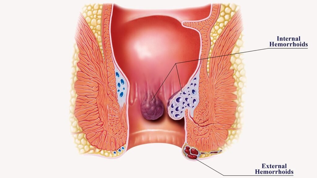 Untreated Hemorrhoids, Internal and External