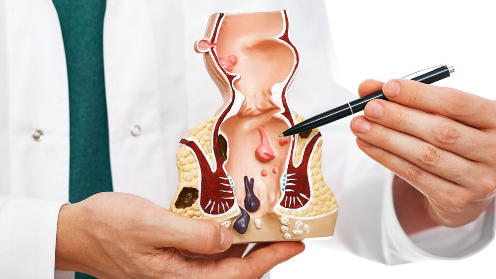 Hemorrhoid doctor
