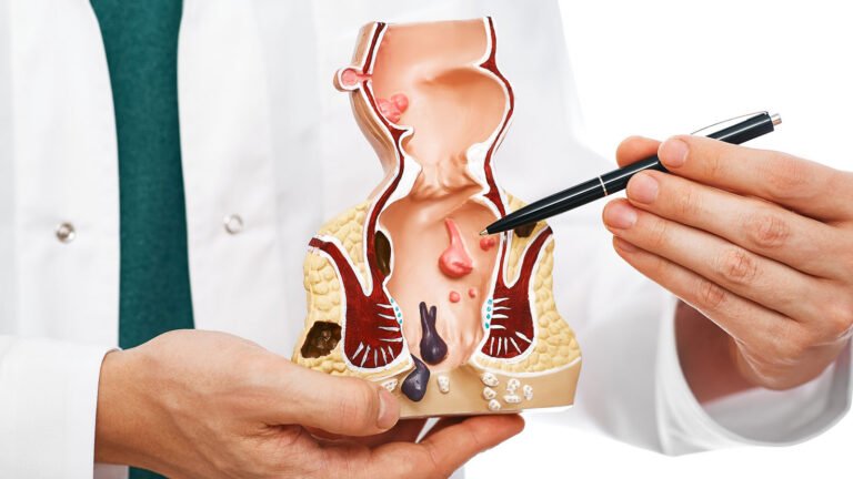 Hemorrhoid doctor