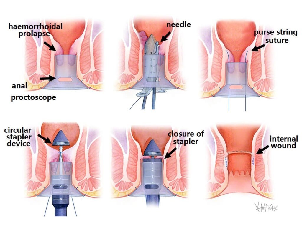 hemorrhoidectomy illustration