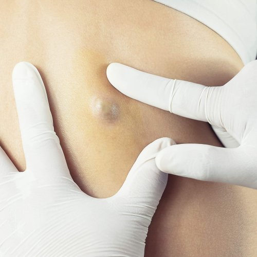 Doctor Diagnosis of the Sebaceous on Woman's Back